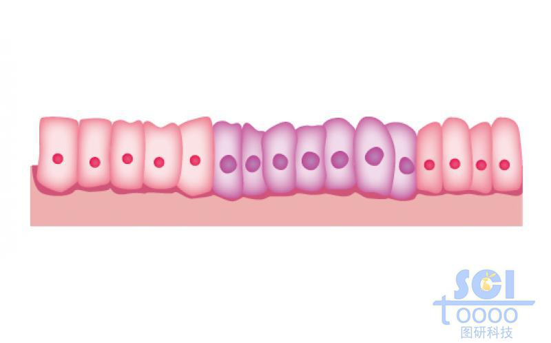 有癌細(xì)胞的腸上皮細(xì)胞
