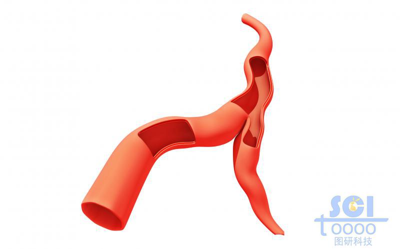 分叉帶兩段切口的血管