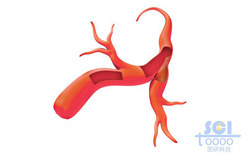 分叉帶兩段切口的血管