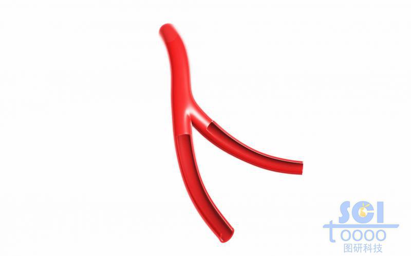 前段帶分支帶切口的血管