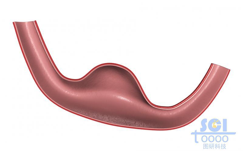 帶腫瘤結(jié)構(gòu)的半剖面的血管示意圖
