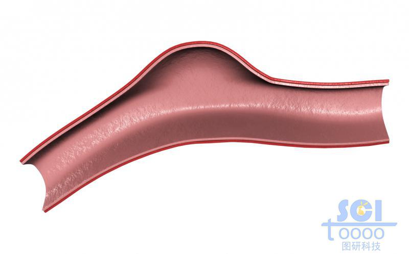 帶腫瘤結(jié)構(gòu)的半剖面的血管示意圖